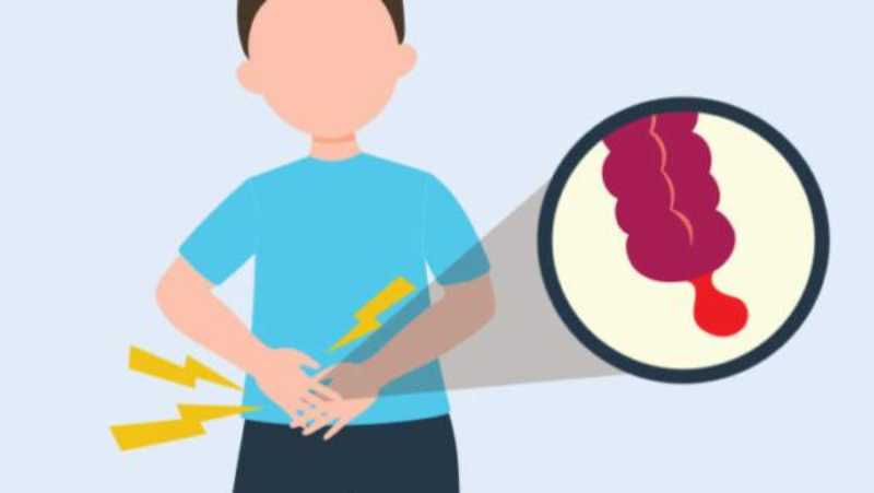 Natural Remedies for Appendicitis