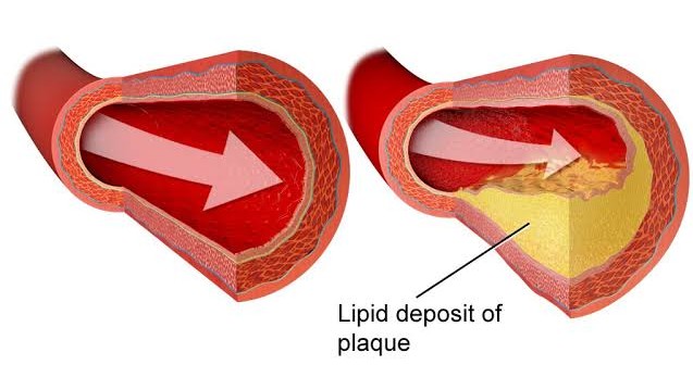 Natural Remedies and Diet for High Blood Pressure