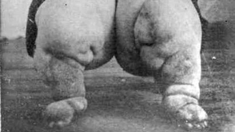 Natural Remedies for Elephantiasis