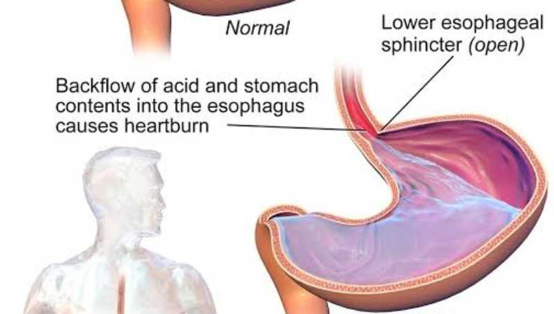 Natural Remedies for Acidity