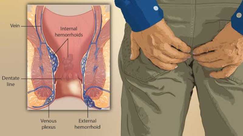 Natural Remedies for Hemorrhoids (Piles)