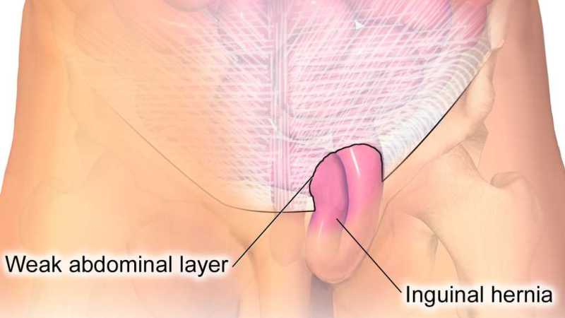 Healing Diet for Hernia
