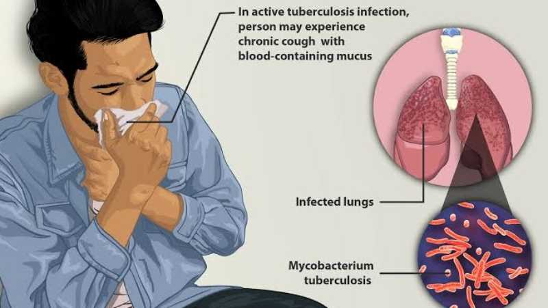 Tuberculosis