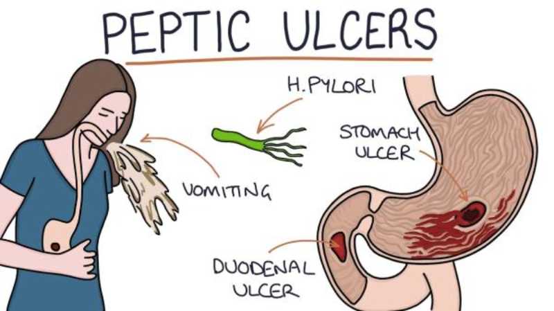 Ulcer